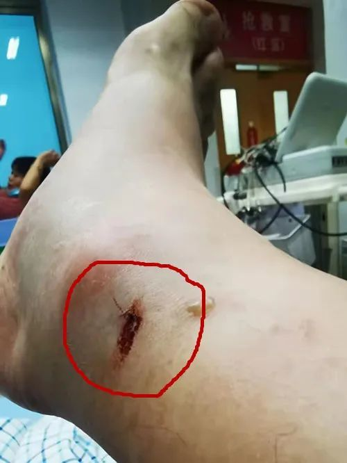 台州男子散步时被超级毒蛇咬了一口！自己一通神操作后得以自救