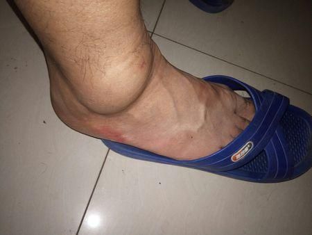 脚崴了怎么处理能快好(5种快速处理方法)